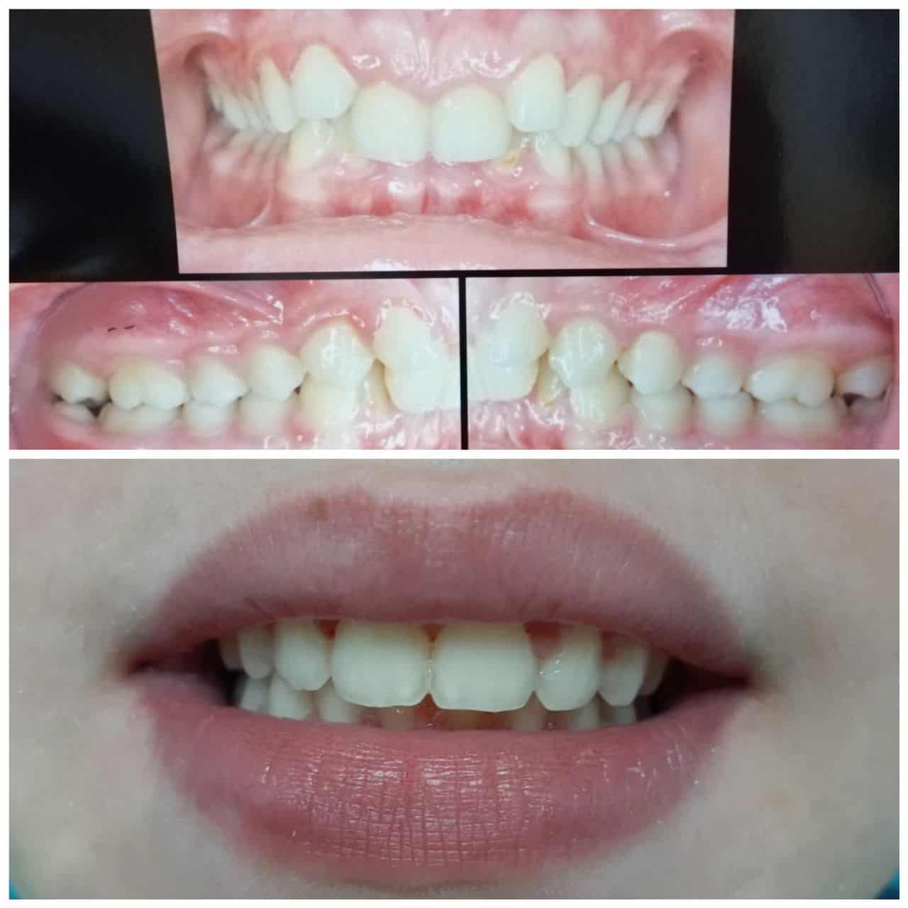 Rezultat ortodonție 4